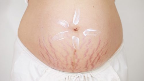 3 Cách làm mờ vết rạn sau sinh cho các mẹ