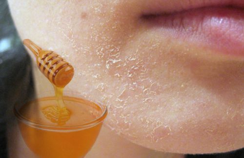 Da mặt khô tróc vẩy vào mùa đông có khó chữa không?