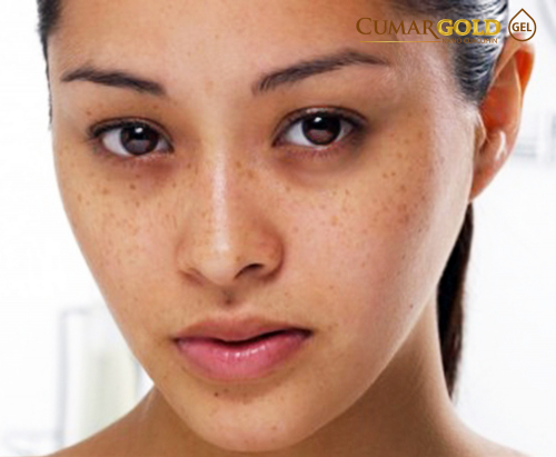 Top 5 bài thuốc chữa nám da mặt được áp dụng nhiều nhất