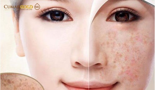 Cách chữa nám da mặt tại nhà giúp vết nám không còn tàn tích