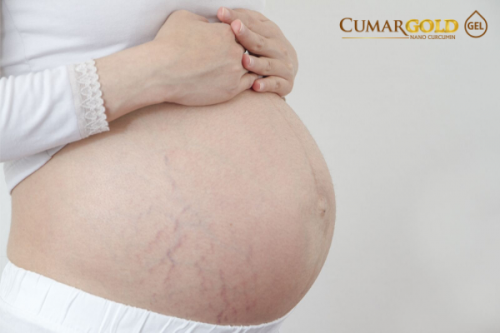 Tiết lộ bí quyết chữa rạn da an toàn nhất cho phụ nữ sau sinh